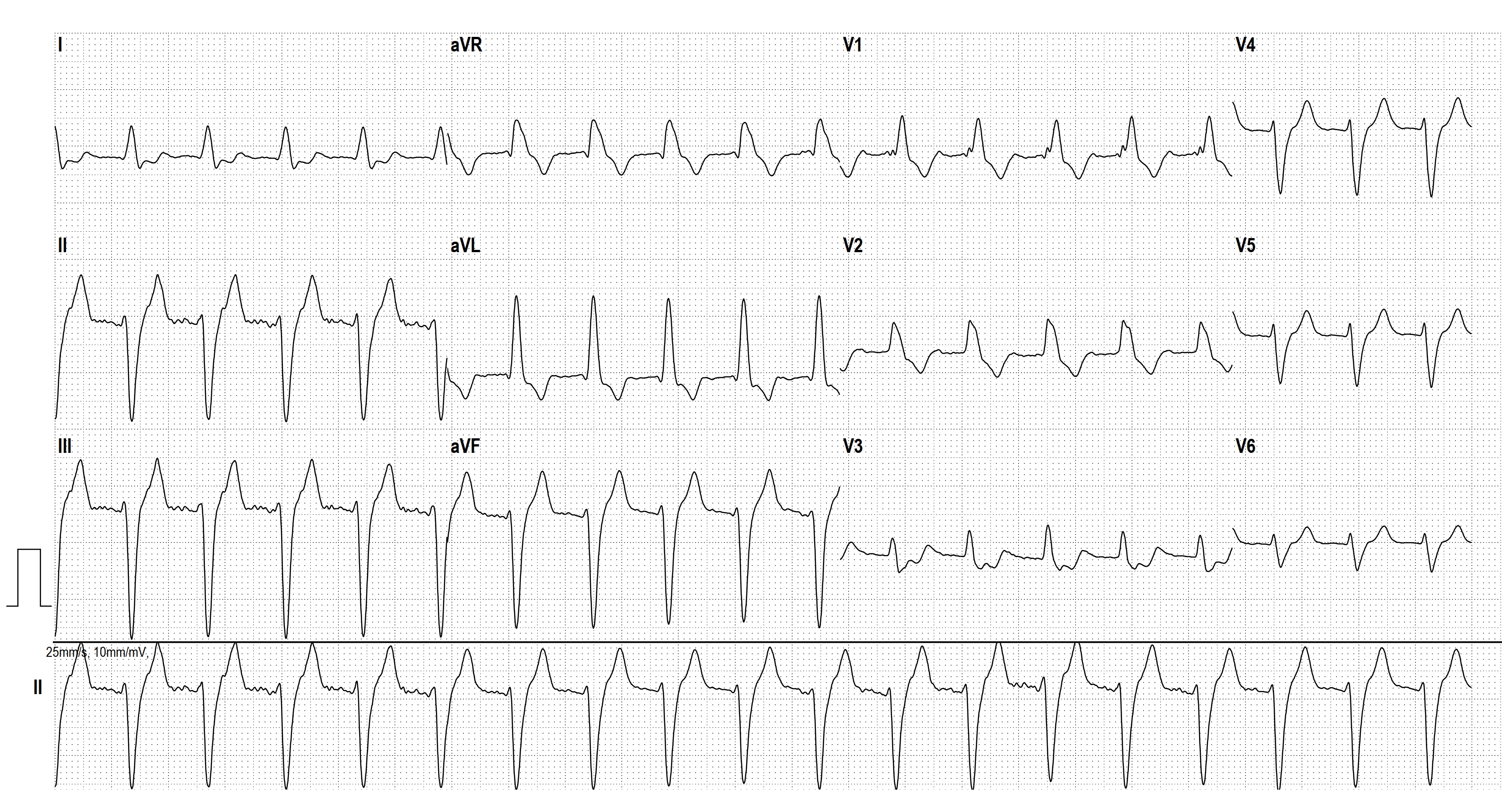 Atrial Flutter With Right Bundle Branch Block And Left Anterior atrial-flutter-with-right-bundle-branch-block-and-left-anterior